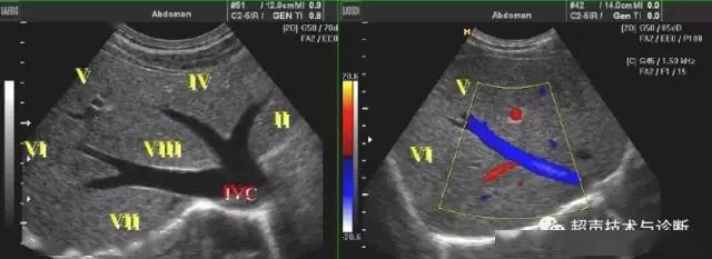 腹部超声 | 实用肝脏分叶,分段及超声对比图