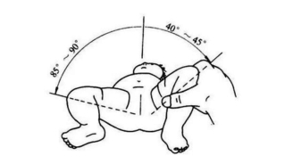 还有蛙式法,意思就是将孩子平卧在床上,膝关节抬起,像青蛙的姿势一样