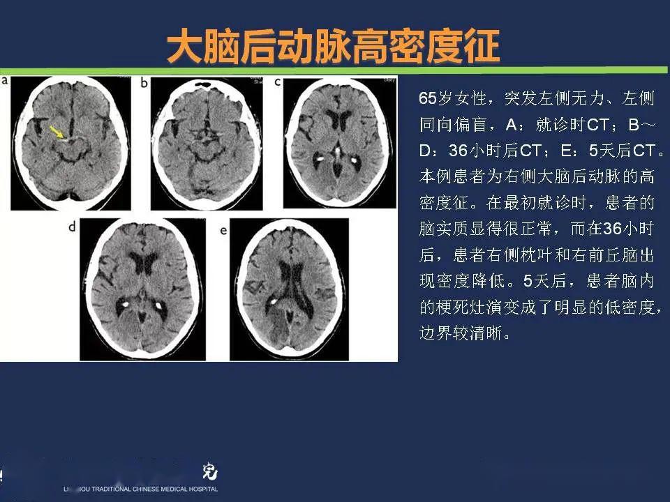 汇总| 超早期脑梗死ct征象