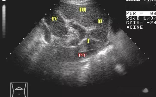腹部超声 | 实用肝脏分叶,分段及超声对比图_门静脉