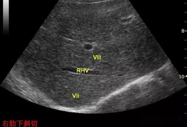 腹部超声实用肝脏分叶分段及超声对比图