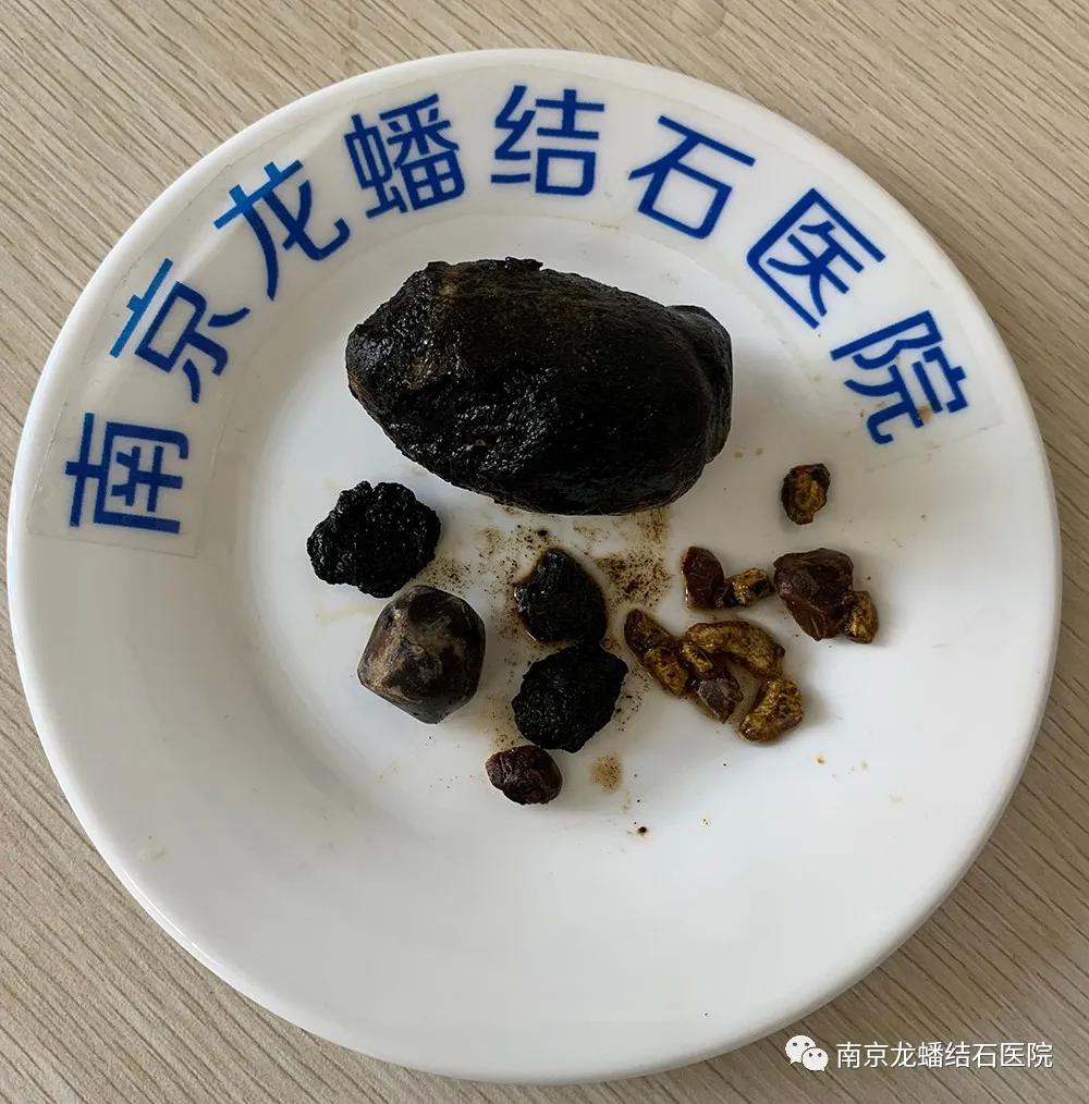 专家提醒:胆结石预防应从生活点滴做起!