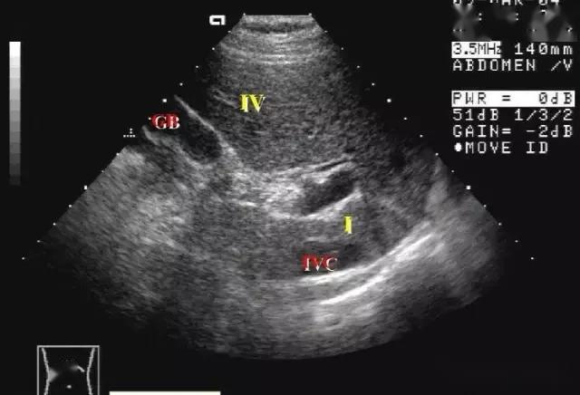 腹部超声实用肝脏分叶分段及超声对比图