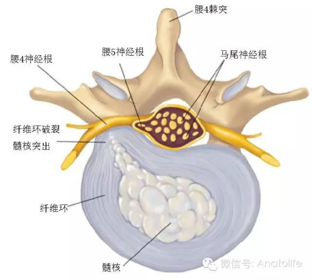 腰椎间盘突出压迫腰4神经根  3  椎管的构成  前壁:椎体后面,椎间盘