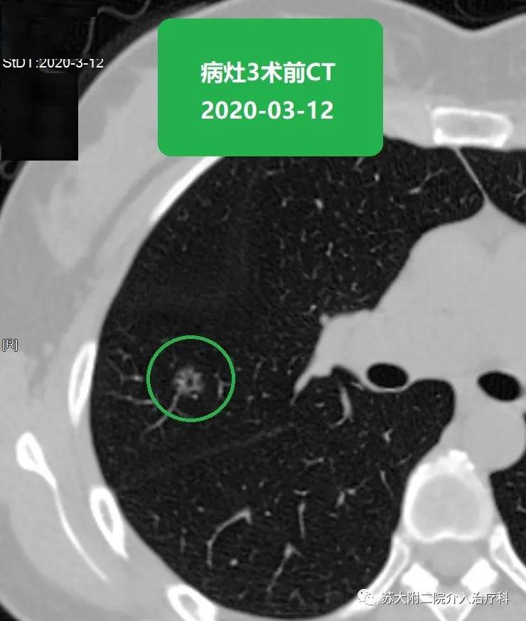 苏大附二院靳勇医生团队病例分享第45期双肺多发磨玻璃结节的消融