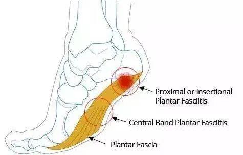 【实用干货】足底筋膜炎的自我康复方法