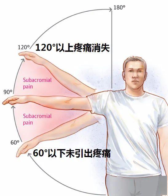 肩膀痛≠肩周炎 区中医院攻