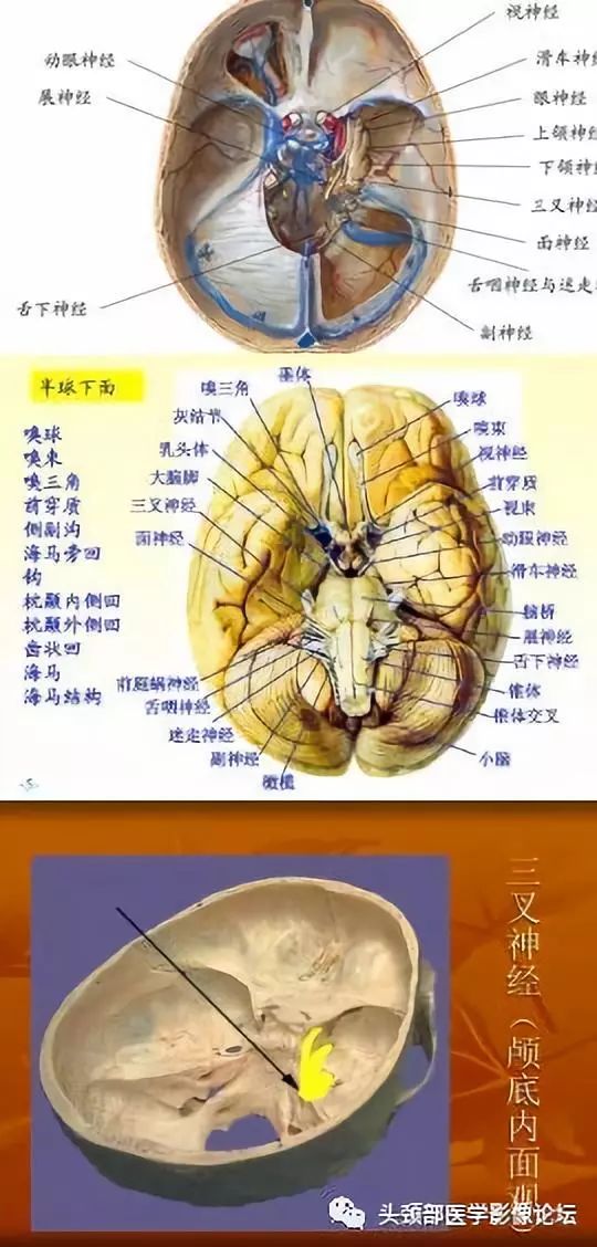 2)颅后窝型:位于桥小脑角区,肿瘤起源于三叉神经后根;1)骑跨颅中后窝