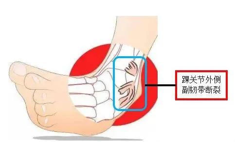户外运动脚踝扭伤怎么办教你如何快速应对