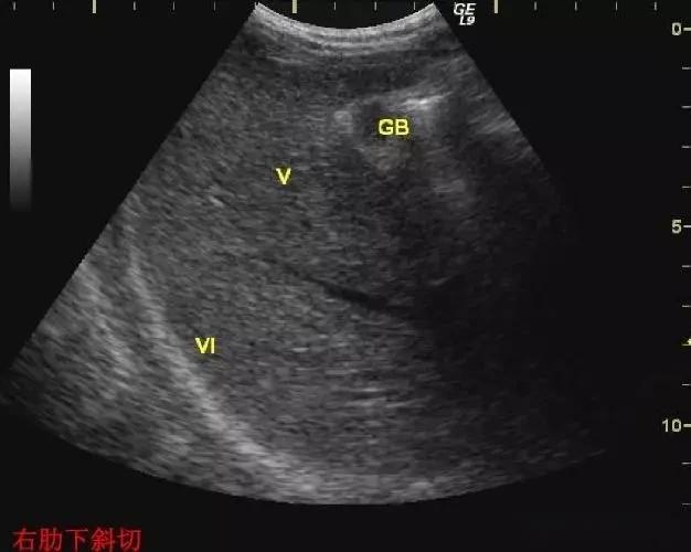 腹部超声实用肝脏分叶分段及超声对比图