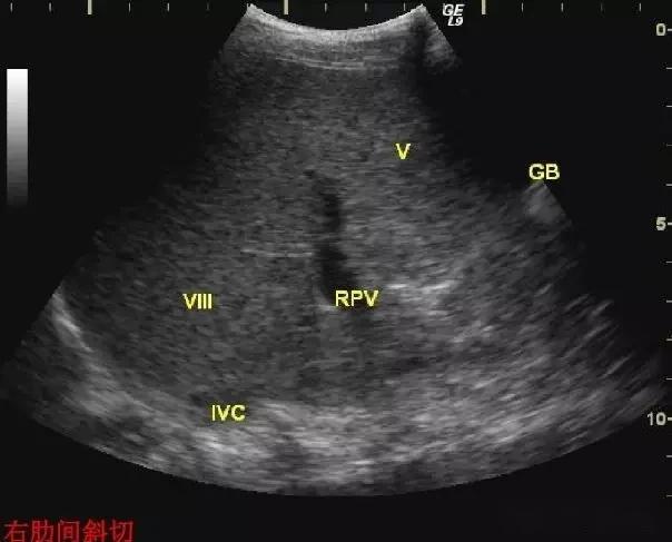 腹部超声实用肝脏分叶分段及超声对比图