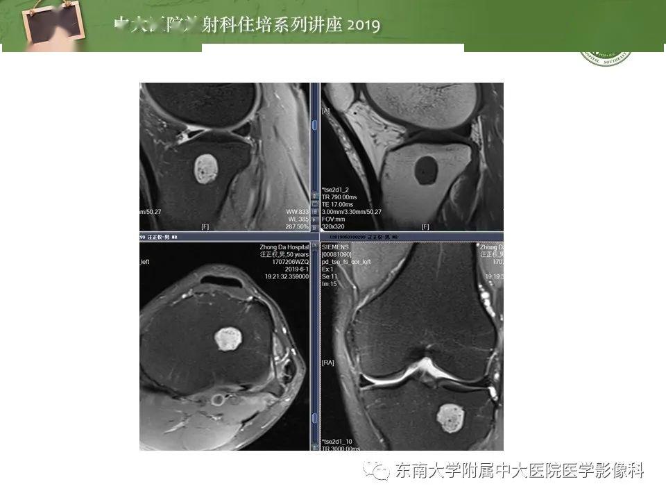 【中大放射住培系列讲座】常见良性骨肿瘤的影像诊断