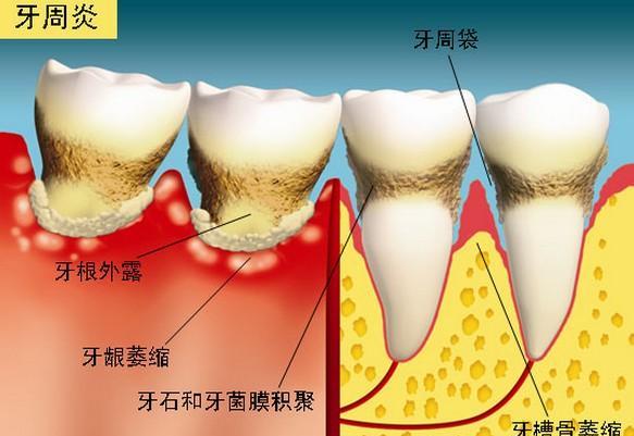 炎症控制了,治愈要相当一段长的时间,慢性牙周炎要1~2年才能稳定