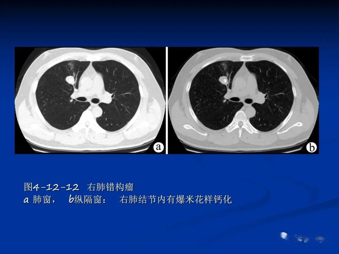 肺肿瘤影像学汇总