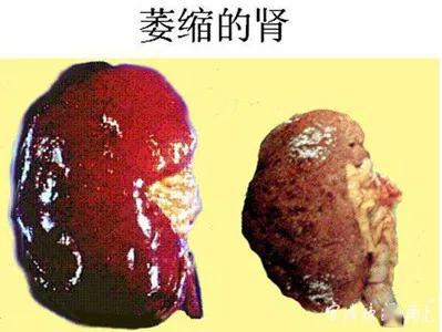 痛心39岁女子全身乏力一查是尿毒症最遗憾3年前错过这信号
