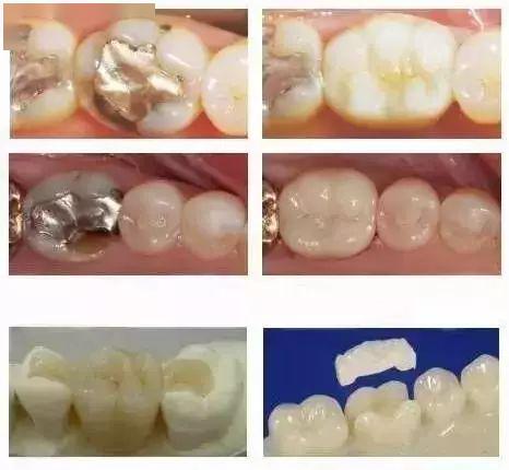 牙体修复的新宠儿——嵌体,到底厉害在哪里?_牙齿