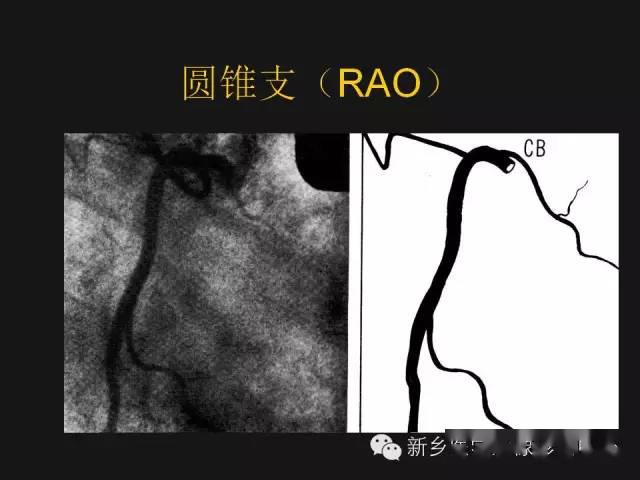 冠状动脉解剖——精细到每一个分支