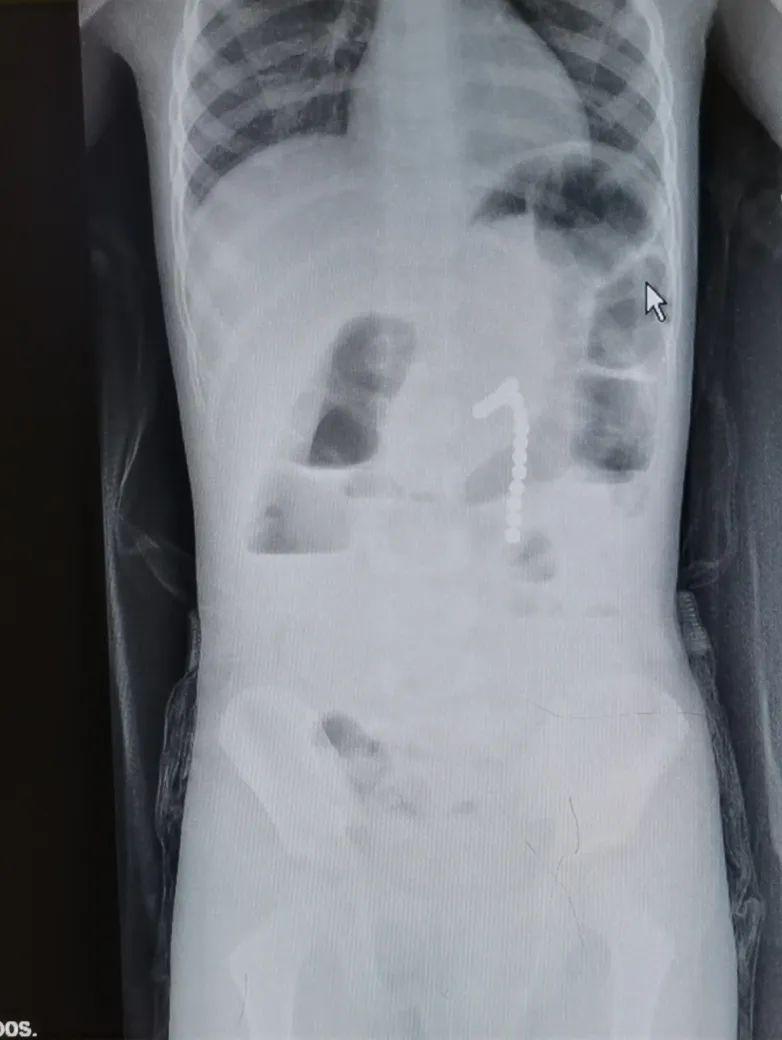 #孩子#孩子的安全叫人揪心坠楼、溺水、吞珠……家长复工后