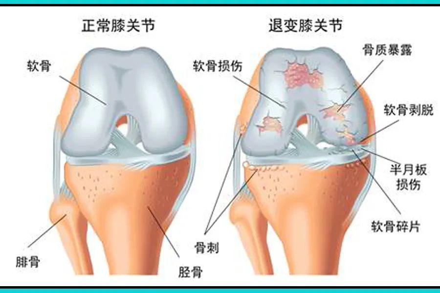 太可怕了跑着跑着膝关节软骨就磨没了