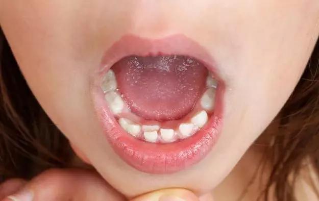 「乳牙」吓坏全家人，牙齿竟变成了这样...孩子一张嘴