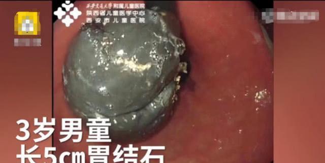 「孩子」爷爷很后悔给娃买这个吃3岁男孩胃里长出5厘米结石