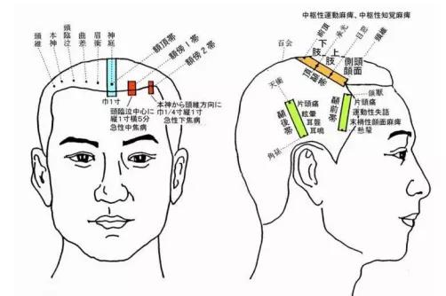 20米开外六亲不认中医六针八养外治法治近视