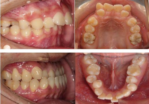 我们常说的龅牙,地包天,牙齿不齐,牙缝过大等问题都属于错颌畸形的