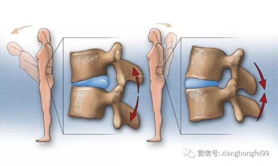 腰椎间盘突出是怎么回事