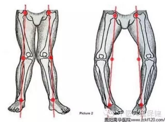 维生素d缺乏性佝偻病引起的o形腿和x形腿的家庭护理