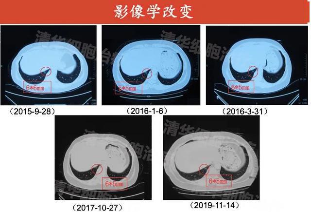 nkt案例分析乳腺癌也能治愈新疗法让她4年未发生转移复发