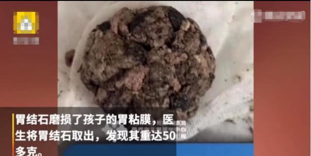 「孩子」爷爷很后悔给娃买这个吃3岁男孩胃里长出5厘米结石