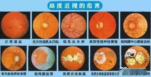 疫情过后近视100度的小学生高中毕业后可能涨到1050d进来我算给你听