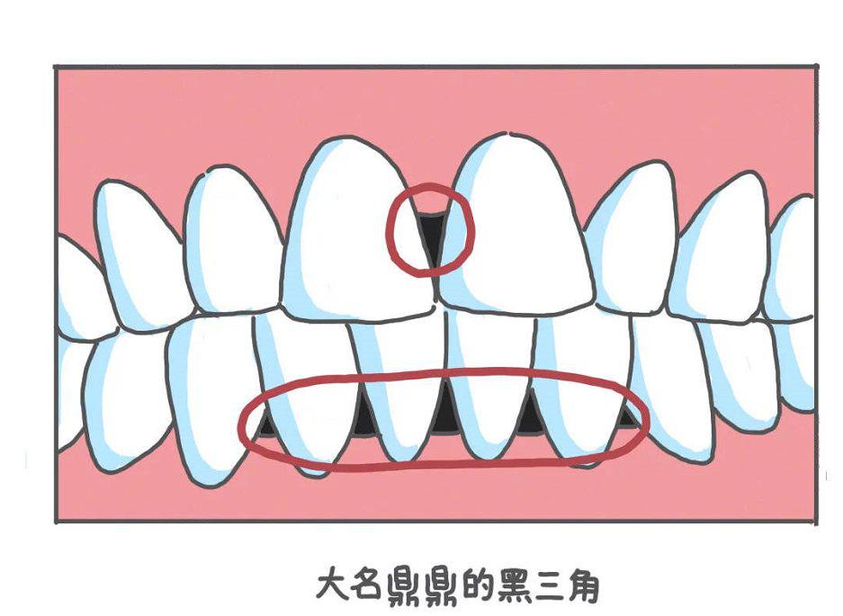 日常刷完牙之后,用水牙线冲洗牙齿之间的缝隙,用完之后整个口腔都是干