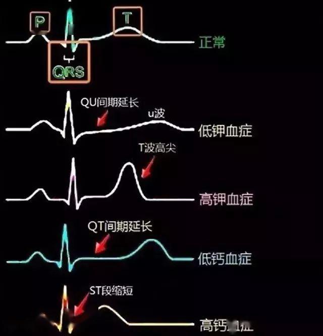 15.电解质紊乱的典型心电图表现