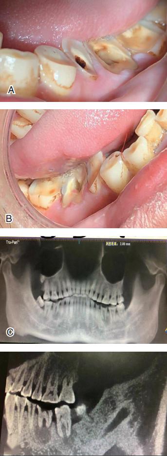 34 岁的槟榔咀嚼者的牙齿严重磨耗,根尖病变,下颌角及颞颌关节的
