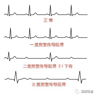 极度风险三度房室传导阻滞