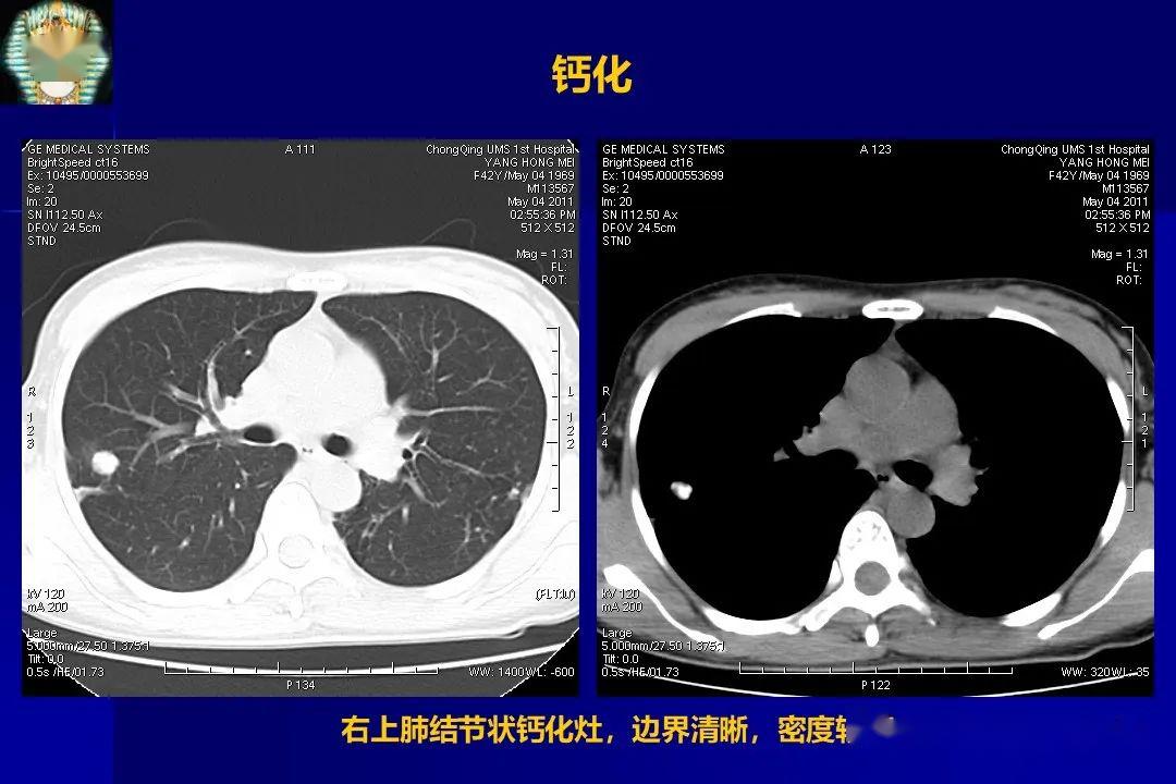 肺结核的影像学诊断