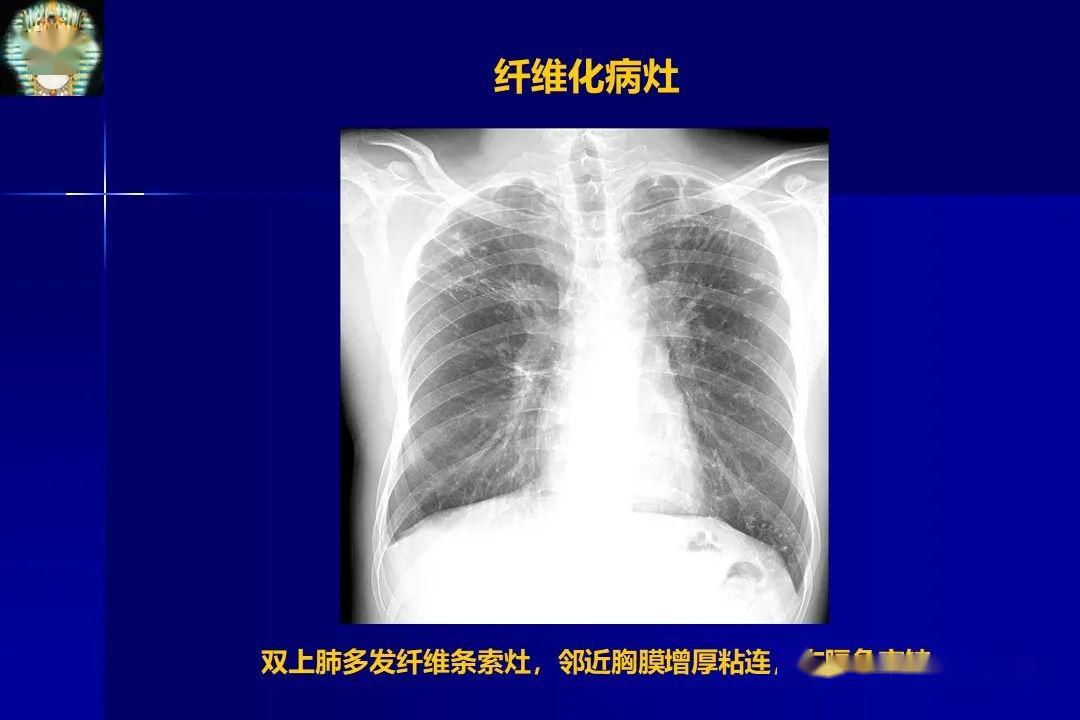 肺结核的影像学诊断