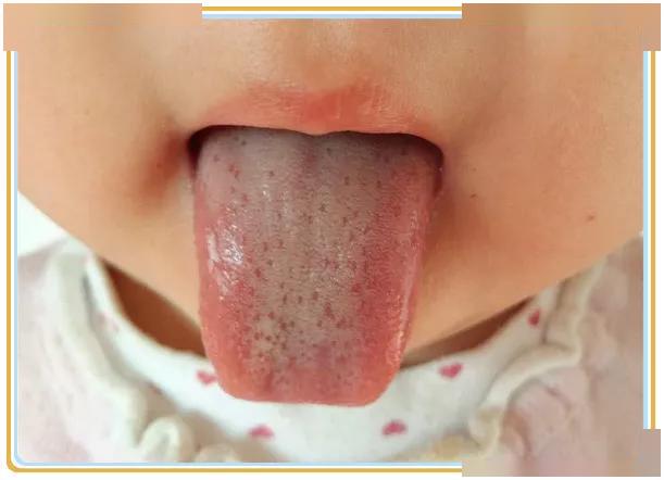 怎么看小孩舌苔厚不厚 617727f3ec2340998e84f8c443ff2a10.jpeg