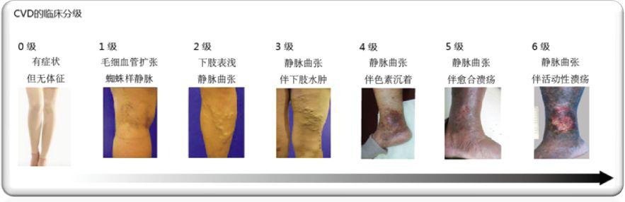 长时间站着、坐着，当心双腿惨不忍睹！32岁小伙小腿都“花”了