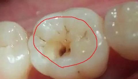 牙缝长出"黑线"别用手抠,学会一个"土方法",不用去洗牙齿了!