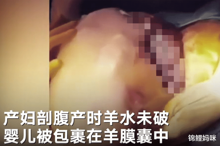 『羊水』羊水清澈五官清晰可见，医生：罕见“气泡宝宝”出生时羊膜未破