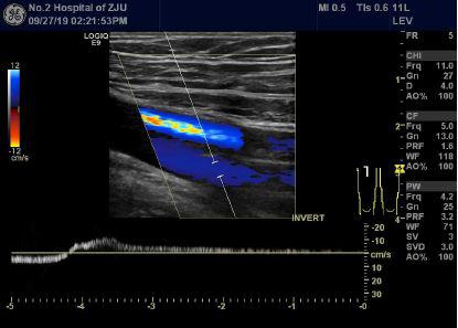 长时间站着、坐着，当心双腿惨不忍睹！32岁小伙小腿都“花”了