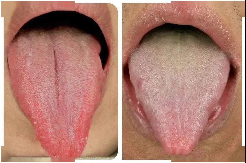 肝气不舒的舌象有些人一伸舌头,舌头伸出来是什么样的呢?