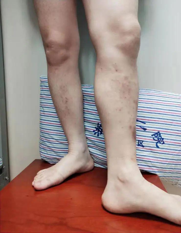 长时间站着、坐着，当心双腿惨不忍睹！32岁小伙小腿都“花”了