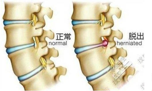 一,腰部疼痛