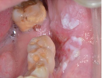 可导致无论是口腔黏膜下纤维性变还是口腔白斑病发生癌变(图10)