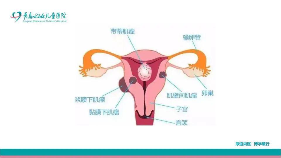 【专家解答】得了子宫肌瘤怎么办,非切不可吗?