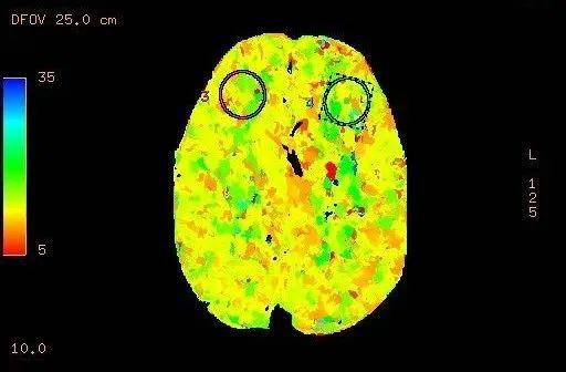 渭南市第二医院医学影像科颅脑cta脑灌注ctp(一站式成像新突破)