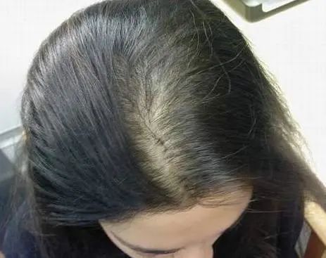 季节性脱发,妊娠脱发,斑秃,还买生发水?不用那么麻烦!